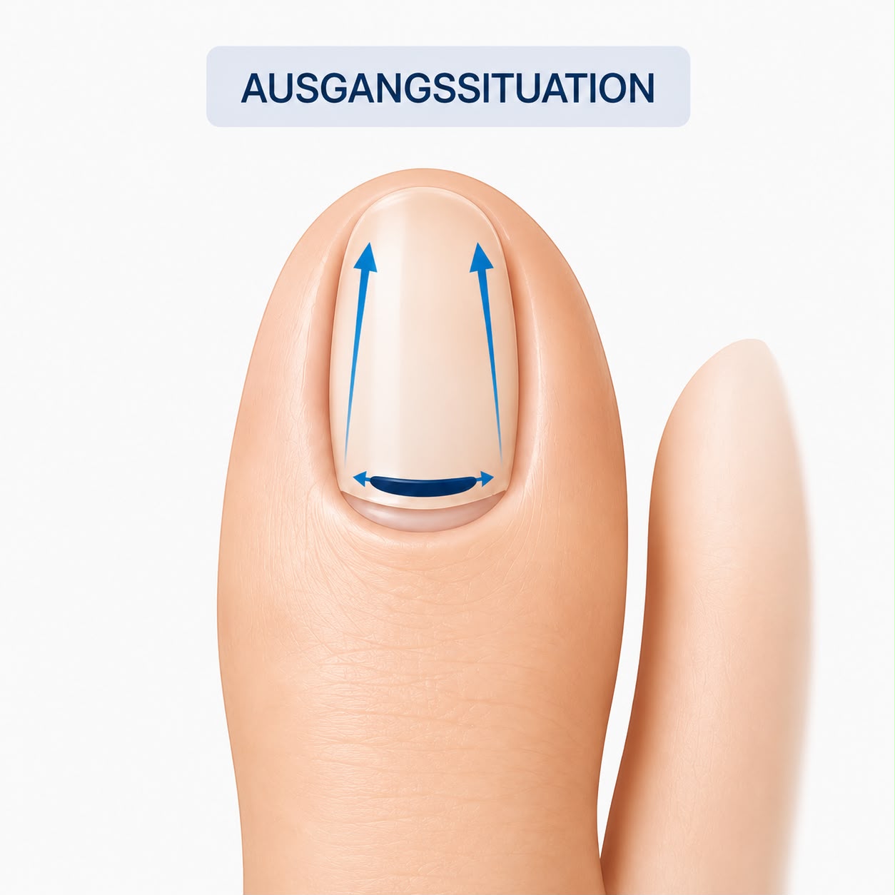 Behandlungsverlauf der Nagelkorrektur – Ausgangssituation
